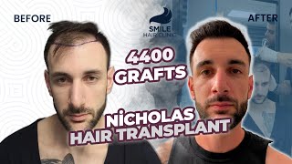 Hairline Restoration  9 Months Hair Transplant Result  Smile Hair Clinic [upl. by Nnaitsirk388]