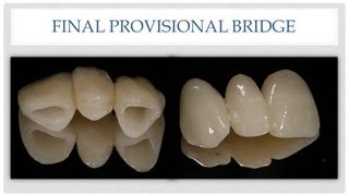 Dental Bridge The Esthetic Provisional Bridge [upl. by Gebler354]