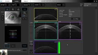 How to use Adjusted IOP correction factor [upl. by Ahsiea]