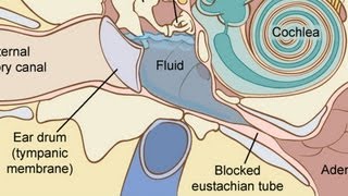 How to Treat Fluid in the Ear  Ear Problems [upl. by Ariuqahs787]