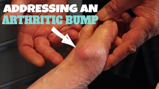 HOW TO ADDRESS AN ARTHRITIC BUMP [upl. by Nrojb838]