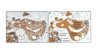 XMRV a New Human Retrovirus Lecture 25 [upl. by Jamille]