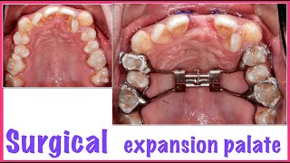 👍Step by step  bimaxillary surgery 👌 [upl. by Mathis]