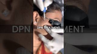 DPN treatment at Skinaa Clinic viral shorts [upl. by Naara]