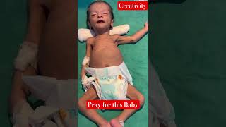 Malnourished Newborn baby medical viral [upl. by Aivek]