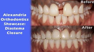 Alexandria Orthodontics Showcase Diastema Closure [upl. by Mcgurn576]