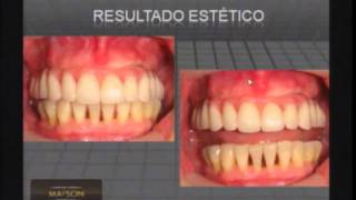 Confecção de protocolo e overdenture [upl. by Bandur677]