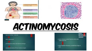 ACTINOMYCOSIS  IMAGES  MCQs [upl. by Ahsilyt]