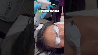 Effortlessly remove brown spots with Cryotherapy—quick minimal pain and effective results [upl. by Jeremias991]