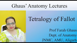 Tetralogy of Fallot [upl. by Nyrok]