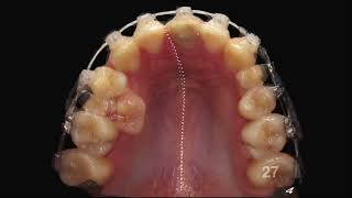 Ортодонтия коррекция верхнего центра Orthodontics upper midline correction [upl. by Boeschen500]