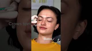 Botox  Where Can It Be Used [upl. by Vivi]