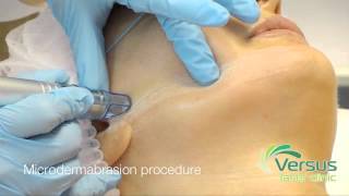 Microdermabrasion step by step demonstration [upl. by Hanleigh]