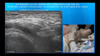 Ultrasound Guided Knee Aspiration amp Injection [upl. by Siraf]