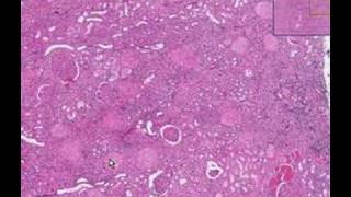 Histopathology KidneyDiabetic glomerulosclerosis [upl. by Sutherlan]