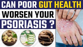 Is Leaky Gut Responsible For Psoriasis  Dr Health  Dr Megha Chaturvedi [upl. by Maire966]