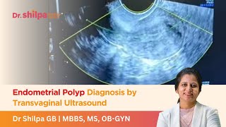 Endometrial Polyp Diagnosis by Transvaginal Ultrasound  Dr Shilpa G B [upl. by Lotti]