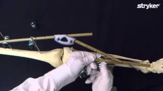 Hoffmann 3 External Fixation System How to build a Knee Bridging Frame with the rod coupler [upl. by Alonso984]