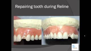 Closed Flask Denture Reline Technique [upl. by Nwadahs]