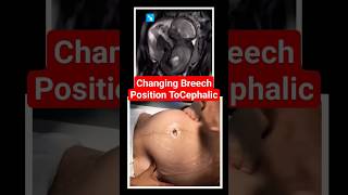 changing breech baby to cephalic position brechbaby babyultrasound babypositionpregnancy [upl. by Leunad]