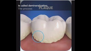 Stage 1 of Tooth Decay Demineralization [upl. by Joete]