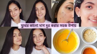 মুখের কালো দাগ দূর করার সহজ উপায়  Reduce Dark Spots Easily At Home  Elma Nur [upl. by Nosylla]