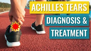 Achilles Tendon Tears  Diagnosis and Treatment of Complete Ruptures [upl. by Nileak]