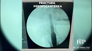 Fractura Pertrocantérea en Cadera casoclínico cadera [upl. by Birk]