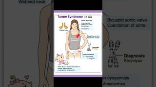 Turners syndrome [upl. by Navanod9]