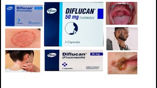 Diflucan tablet  Uses  Side effects  HindiUrdu [upl. by Ecnedurp931]