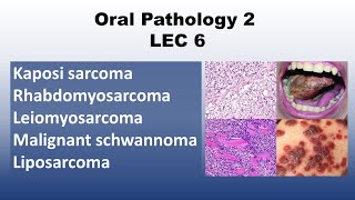 Oral Pathology 2  LEC 6 Kaposi sarcoma  Rhabdomyosarcoma  Leiomyosarcoma [upl. by Seldon821]