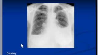 Chest xray  Pleural effusion Pneumonia [upl. by Alvis591]