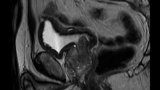 Robotassisted radical prostatectomy with a median lobe [upl. by Suitangi871]