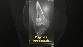 Knee joint Osteomyelitis shortvideo viralshorts osteomyelitis [upl. by Laden]