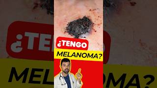 ¿Ese Lunar es un MELANOMA Descubre el ABCDE del Melanoma Maligno [upl. by Hametaf]