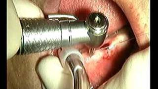 Monoimplante  Monoblock Implant [upl. by Melonie442]