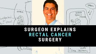 Surgeon Explains Rectal Cancer Surgery [upl. by Orecic101]