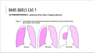 le Drainage Thoracique chez un patient à Hôpital [upl. by Aixela84]