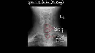 Spina Bifida X ray vs Normal  Spina Bifida Anatomy Animation Radiology  Spina bifida shorts [upl. by Aenel]