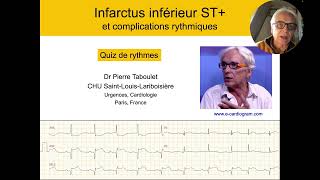 Infarctus inférieur et troubles du rythme Dr Taboulet [upl. by Ludovico]