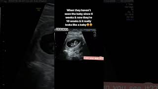 Can you see it 10 week baby movement pregnancy pregnancycare ultrasound [upl. by Nylarak721]