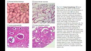 Chronic Interstitial Nephritis amp Papillary Necrosis [upl. by Ycnaffit]