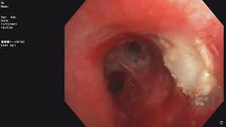 Central Airway Tumor  Bronchoscopic recanalisation  Pleomorphic adenoma [upl. by Nnyllaf]