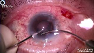 Cataracte mauvaise dilatation symblepharon phaco sans écarteur gestion dhernie de l’iris iol toric [upl. by Timon]