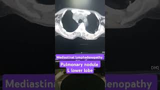 Mediastinal lymphadenopathy on CT scan pulmonary nodule on CT scan [upl. by Barbabas510]