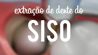 Extração de dente do siso [upl. by Arikal583]