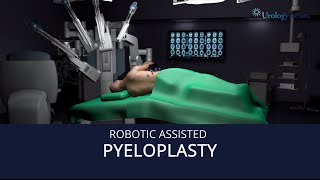 Robot Assisted Pyeloplasty [upl. by Eimarrej]