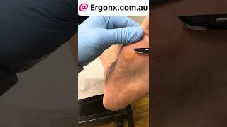 Callus removal by podiatrist [upl. by Koren]