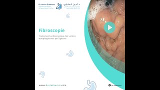 Fibroscopie  Traitement endoscopique des varices œsophagiennes par ligature [upl. by Ailgna772]