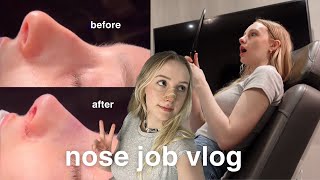 nose job vlog  rhinoplasty recovery amp results [upl. by Peer]